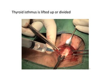 Thyroid isthmus is lifted up or divided
67
 