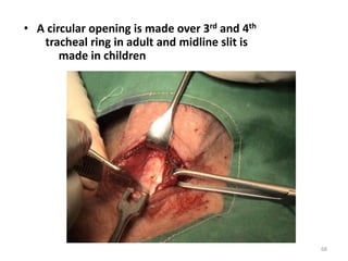 • A circular opening is made over 3rd and 4th
tracheal ring in adult and midline slit is
made in children
68
 