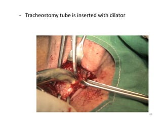 - Tracheostomy tube is inserted with dilator
69
 