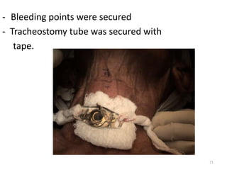 - Bleeding points were secured
- Tracheostomy tube was secured with
tape.
71
 