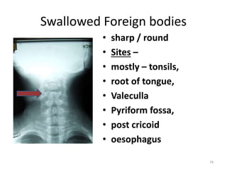 Swallowed Foreign bodies
• sharp / round
• Sites –
• mostly – tonsils,
• root of tongue,
• Valeculla
• Pyriform fossa,
• post cricoid
• oesophagus
79
 