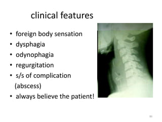 clinical features
• foreign body sensation
• dysphagia
• odynophagia
• regurgitation
• s/s of complication
(abscess)
• always believe the patient!
80
 