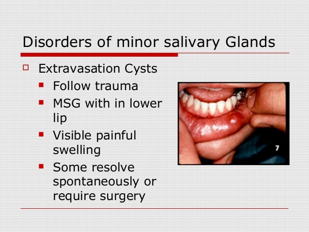 Salivary Glands Disorders