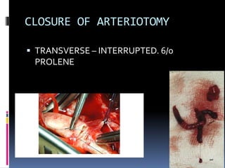 CLOSURE OF ARTERIOTOMY
 TRANSVERSE – INTERRUPTED. 6/0
PROLENE
 