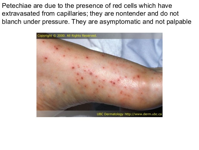 Thrombocytopenia