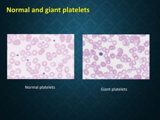 Normal and giant platelets
Normal platelets Giant platelets
 