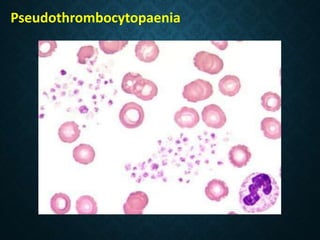 Pseudothrombocytopaenia
 