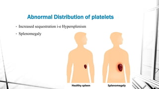 • Increased sequestration i-e Hypersplenism
• Splenomegaly
Abnormal Distribution of platelets
 