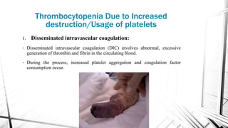 Thrombocytopenia Due to Increased
destruction/Usage of platelets
1. Disseminated intravascular coagulation:
• Disseminated intravascular coagulation (DIC) involves abnormal, excessive
generation of thrombin and fibrin in the circulating blood.
• During the process, increased platelet aggregation and coagulation factor
consumption occur.
 