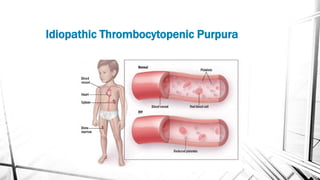 Idiopathic Thrombocytopenic Purpura
 