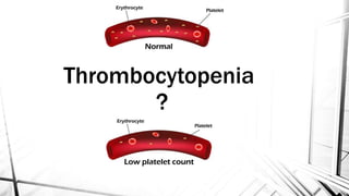 Thrombocytopenia
?
 