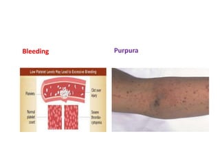 Bleeding Purpura
 