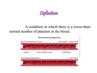 Definition
A condition in which there is a lower-than-
normal number of platelets in the blood.
 