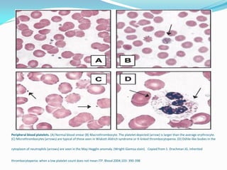 Peripheral blood platelets. (A) Normal blood smear (B) Macrothrombocyte. The platelet depicted (arrow) is larger than the average erythrocyte.
(C) Microthrombocytes (arrows) are typical of those seen in Wiskott-Aldrich syndrome or X-linked thrombocytopenia. (D) Döhle-like bodies in the
cytoplasm of neutrophils (arrows) are seen in the May-Hegglin anomaly. (Wright-Giemsa stain). Copied from 1. Drachman JG. Inherited
thrombocytopenia: when a low platelet count does not mean ITP. Blood 2004;103: 390-398
 