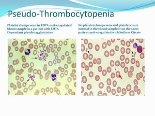 Pseudo-Thrombocytopenia
Platelet clumps seen in EDTA anti-coagulated
blood sample in a patient with EDTA
Dependant platelet aggluttinins
No platelet clumps seen and platelet count
normal in the blood sample from the same
patient anti-coagulated with Sodium Citrate
 