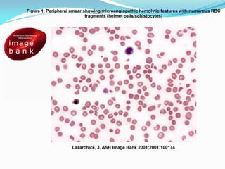 Lazarchick, J. ASH Image Bank 2001;2001:100174
Figure 1. Peripheral smear showing microangiopathic hemolytic features with numerous RBC
fragments (helmet cells/schistocytes)
 