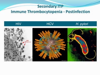 Secondary ITP
Immune Thrombocytopenia - Postinfection
HIV HCV H. pylori
 