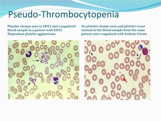 Pseudo-Thrombocytopenia Platelet clumps seen in EDTA anti-coagulated blood sample in a patient with EDTA Dependant platelet aggluttinins No platelet clumps seen and platelet count normal in the blood sample from the same patient anti-coagulated with Sodium Citrate 