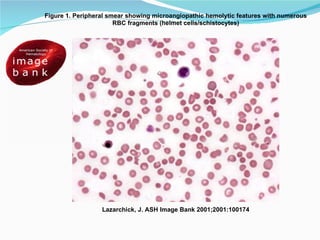 Lazarchick, J. ASH Image Bank 2001;2001:100174 Figure 1. Peripheral smear showing microangiopathic hemolytic features with numerous RBC fragments (helmet cells/schistocytes) 