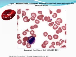Copyright ©2001 American Society of Hematology.  Copyright restrictions may apply. Lazarchick, J. ASH Image Bank 2001;2001:100174 Figure 2. Peripheral smear showing RBC fragmentation consistent with a microangiopathic hemolytic process 