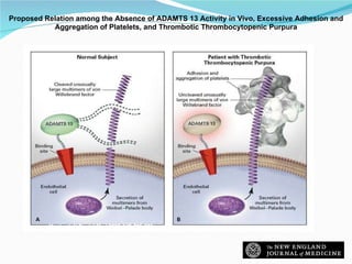 Moake J. N Engl J Med 2002;347:589-600 Proposed Relation among the Absence of ADAMTS 13 Activity in Vivo, Excessive Adhesion and Aggregation of Platelets, and Thrombotic Thrombocytopenic Purpura 