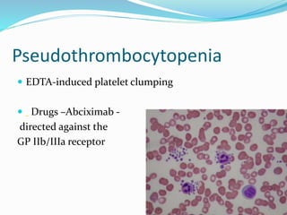 Pseudothrombocytopenia
 EDTA-induced platelet clumping
 Drugs –Abciximab -
directed against the
GP IIb/IIIa receptor
 