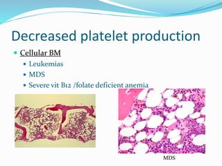 Decreased platelet production
 Cellular BM
 Leukemias
 MDS
 Severe vit B12 /folate deficient anemia
MDS
 