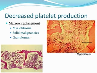 Decreased platelet production
 Marrow replacement
 Myelofibrosis
 Solid malignancies
 Granulomas
Myelofibrosis
 