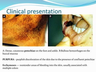 Clinical presentation
A: Dense, cutaneous petechiae on the foot and ankle. B:Bullous hemorrhages on the
buccal mucosa
PURPURA - purplish discoloration of the skin due to the presence of confluent petechiae
Ecchymoses — nontender areas of bleeding into the skin, usually associated with
multiple colors
 