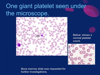 One giant platelet seen under
the microscope.

Below: shows a
normal platelet
count.

Bone marrow slide was requested for
further investigations.

 