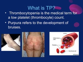 What is TP?
• Thrombocytopenia is the medical term for
a low platelet (thrombocyte) count.
• Purpura refers to the development of
bruises.

 