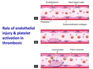 Role of endothelial
injury & platelet
activation in
thrombosis
 