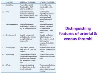 Distinguishing
features of arterial &
venous thrombi
 
