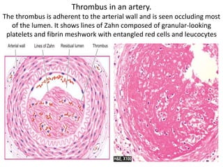 Thrombus in an artery.
The thrombus is adherent to the arterial wall and is seen occluding most
of the lumen. It shows lines of Zahn composed of granular-looking
platelets and fibrin meshwork with entangled red cells and leucocytes
 
