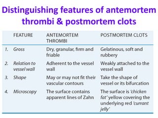 Distinguishing features of antemortem
thrombi & postmortem clots
 