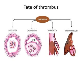 Fate of thrombus
 