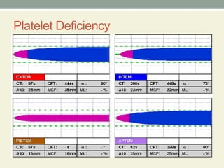 Teg Rotem Machine Comprehensive Overview of Thromboelastography (TEG) and Rotational ...