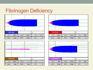 Teg Rotem Machine Comprehensive Overview of Thromboelastography (TEG) and Rotational ...
