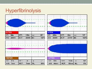Teg Rotem Machine Comprehensive Overview of Thromboelastography (TEG) and Rotational ...
