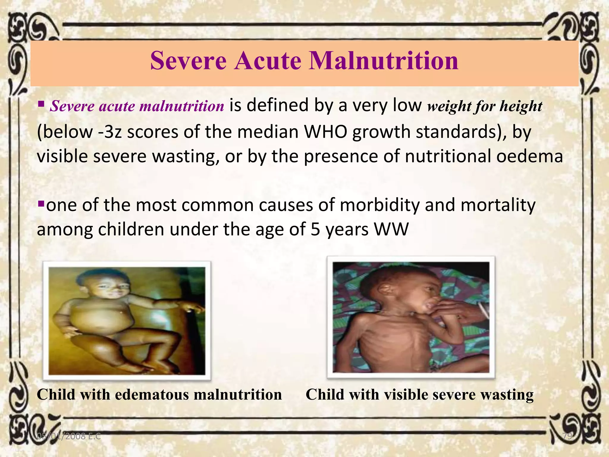 Severe Acute Malnutrition
05/01/2008 E.C 79
Child with visible severe wastingChild with edematous malnutrition
 Severe acute malnutrition is defined by a very low weight for height
(below -3z scores of the median WHO growth standards), by
visible severe wasting, or by the presence of nutritional oedema
one of the most common causes of morbidity and mortality
among children under the age of 5 years WW
 