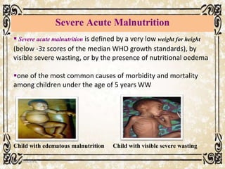Severe Acute Malnutrition
05/01/2008 E.C 79
Child with visible severe wastingChild with edematous malnutrition
 Severe acute malnutrition is defined by a very low weight for height
(below -3z scores of the median WHO growth standards), by
visible severe wasting, or by the presence of nutritional oedema
one of the most common causes of morbidity and mortality
among children under the age of 5 years WW
 