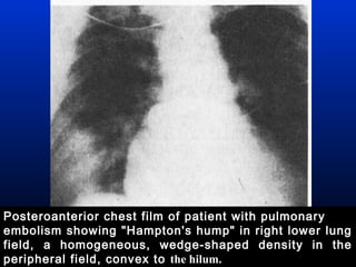 Posteroanterior chest film of patient with pulmonary
embolism showing "Hampton's hump" in right lower lung
field, a homogeneous, wedge-shaped density in the
peripheral field, convex to the hilum.

 