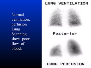 Normal
ventilation,
perfusion
Lung
Scanning
show poor
flow of
blood.

 