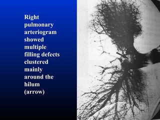 Right
pulmonary
arteriogram
showed
multiple
filling defects
clustered
mainly
around the
hilum
(arrow)

 