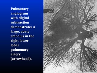 Pulmonary
angiogram
with digital
subtraction
demonstrates a
large, acute
embolus in the
right lower
lobar
pulmonary
artery
(arrowhead).

 