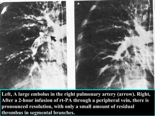 Left, A large embolus in the right pulmonary artery (arrow). Right,
After a 2-hour infusion of rt-PA through a peripheral vein, there is
pronounced resolution, with only a small amount of residual
thrombus in segmental branches.

 