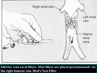 Inferior vena caval filters. Most filters are placed percutaneouslv via
the right femoral vein. Bird's Nest Filter

 