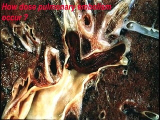 How dose pulmonary embolism
occur ?

 