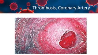 Thrombosis, Coronary Artery
 