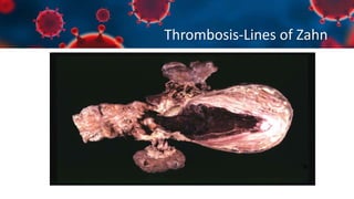 Thrombosis-Lines of Zahn
 